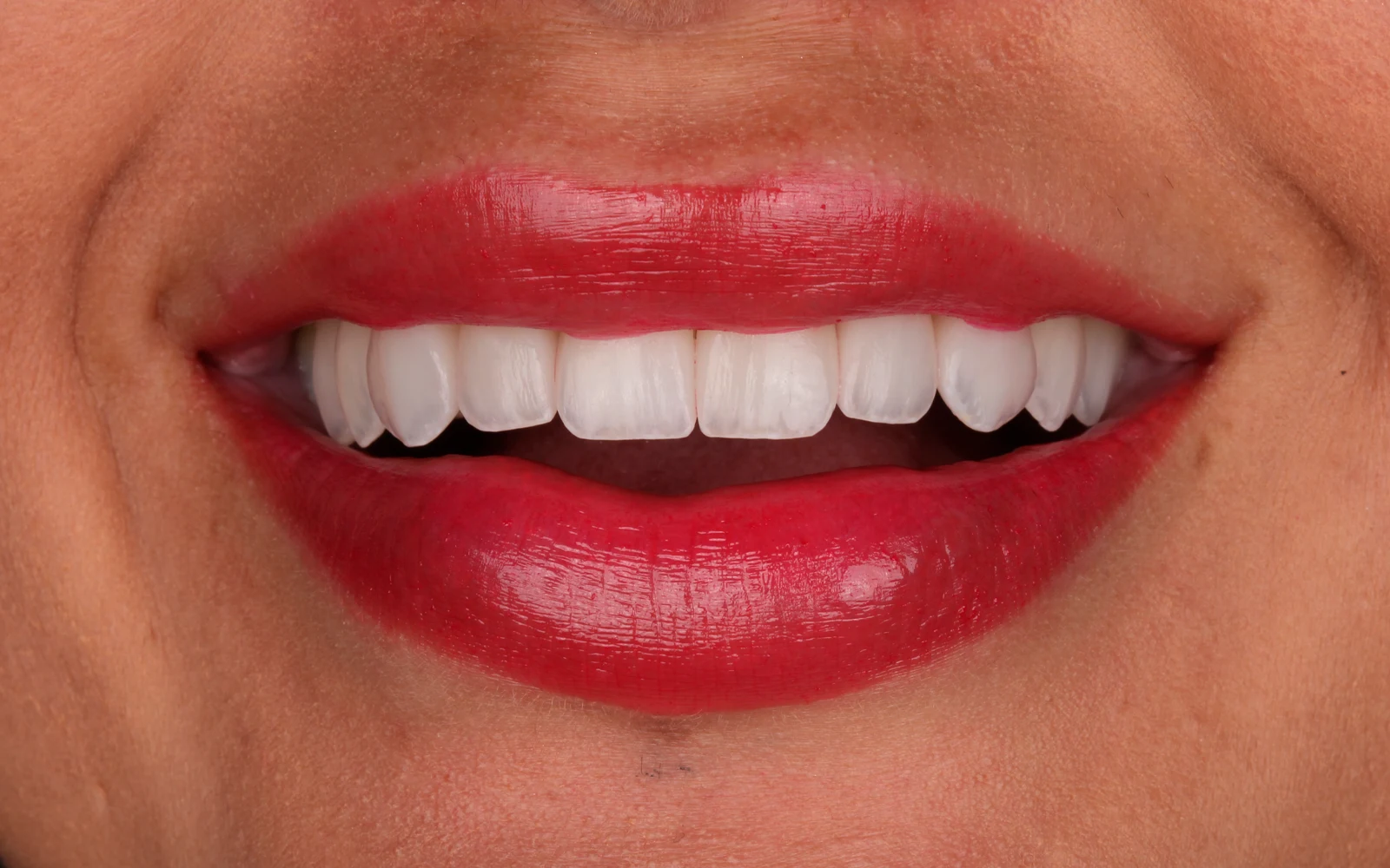 Depois do tratamento Lentes de Contato - Porcelana
